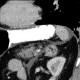 Adrenal myelolipoma: CT - Computed tomography